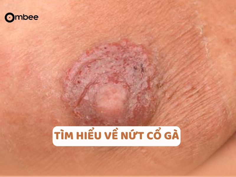 nut-co-ga-co-nghiem-trong-khong-1